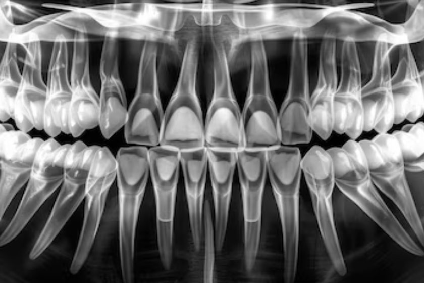 Panoramic dental x-ray with the flagged area circled